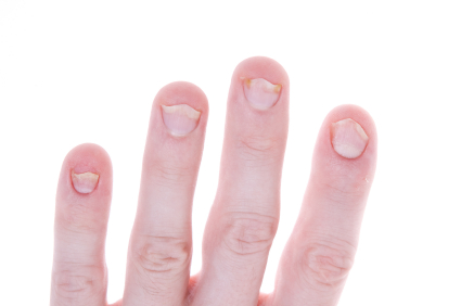 Psoriasis Nail Infection