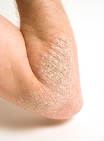 Psoriasis Skin Plaques